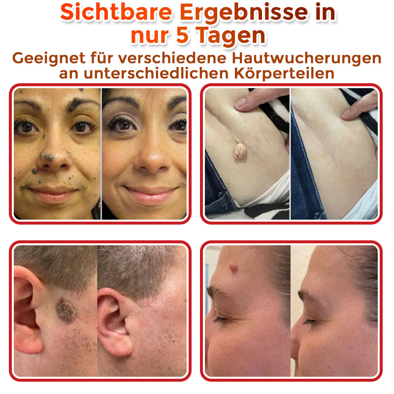 GFOUK® Mikronadeln Botanisch Hautanhängsel Entfernung Patch
