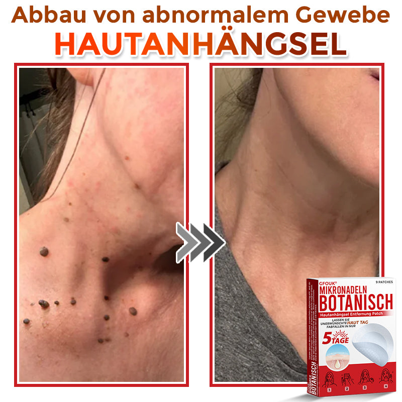 GFOUK® Mikronadel-Botanisches Hautanhängsel-Entfernungspflaster 🇩🇪 Hergestellt in Deutschland