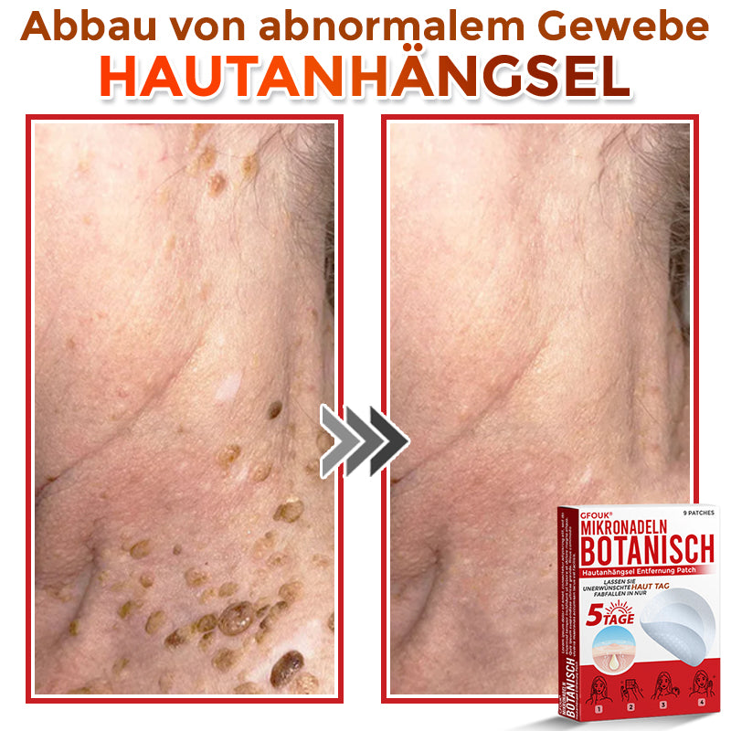 GFOUK® Mikronadeln Botanisch Hautanhängsel Entfernung Patch
