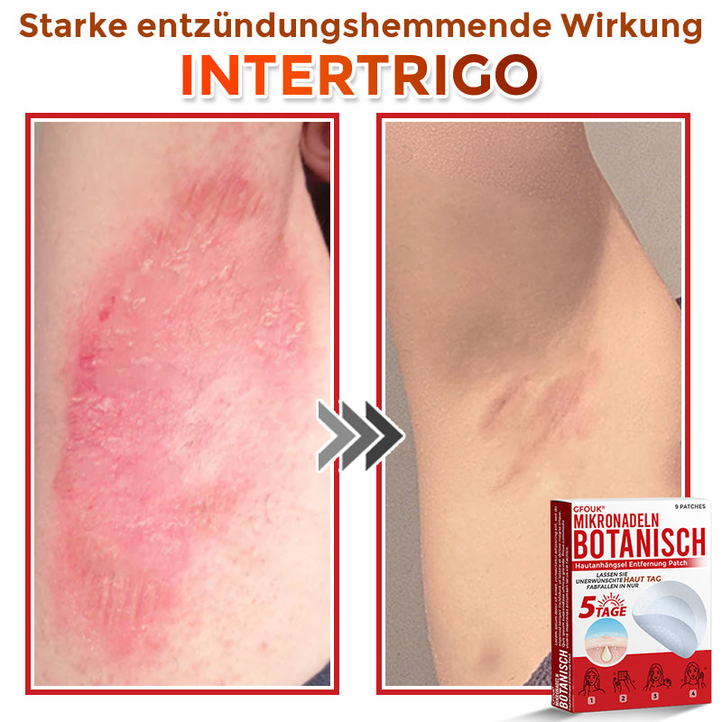 GFOUK® Mikronadel-Botanisches Hautanhängsel-Entfernungspflaster 🇩🇪 Hergestellt in Deutschland