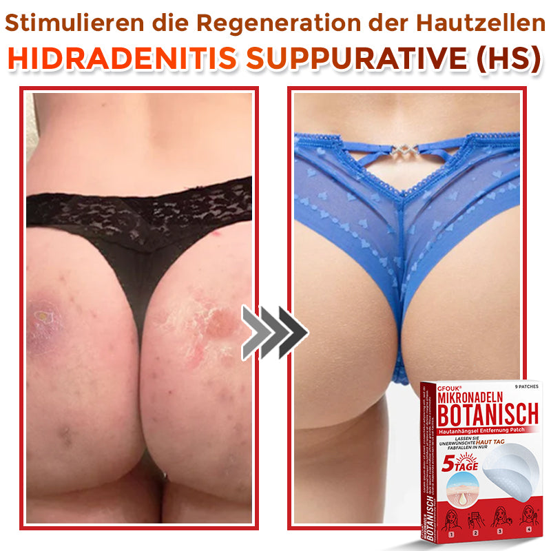 GFOUK® Mikronadel-Botanisches Hautanhängsel-Entfernungspflaster 🇩🇪 Hergestellt in Deutschland