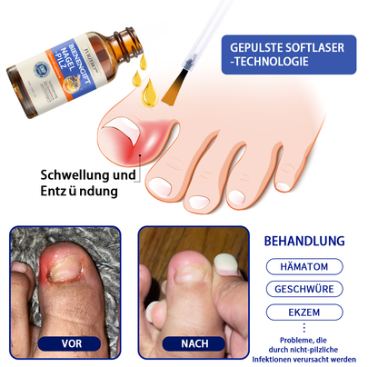 🐝Furzero™ Bienengift Nagelpilz Behandlungslösung:Schnell wirksam und verhindert Rückfälle🌟