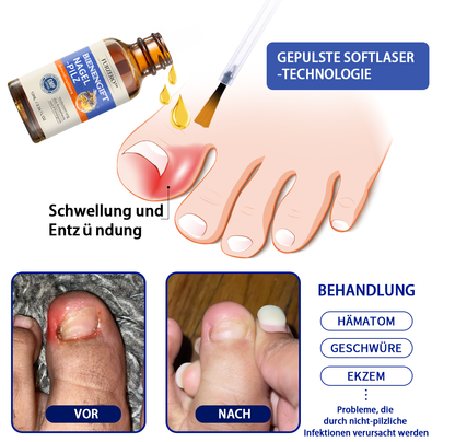 🐝👣Furzero™ Bienengift Nagelpilz Behandlungslösung:Das Nagelpilzproblem vollständig lösen🌟