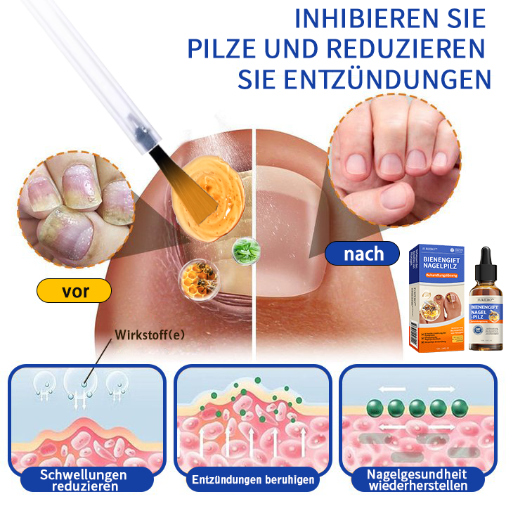 🐝Furzero™ Bienengift Nagelpilz Behandlungslösung:Schnell wirksam und verhindert Rückfälle🌟