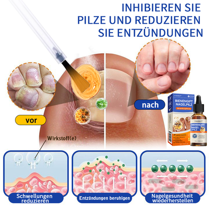 🐝👣Furzero™ Bienengift Nagelpilz Behandlungslösung:Das Nagelpilzproblem vollständig lösen🌟