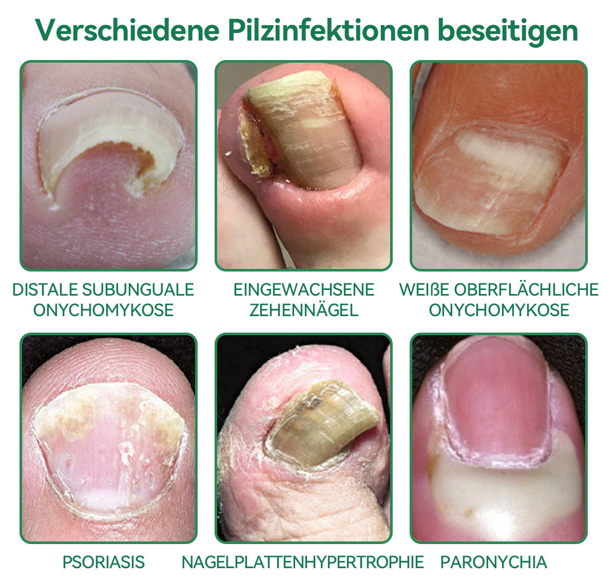 🐝🐝Furzero™ Bienengift Nagelpilz Behandlungslösung:Eine sichere und natürliche Methode zur Nagelbehandlung!👣👣