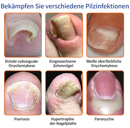 🐝👣Furzero™ Bienengift Nagelpilz Behandlungslösung:Das Nagelpilzproblem vollständig lösen🌟