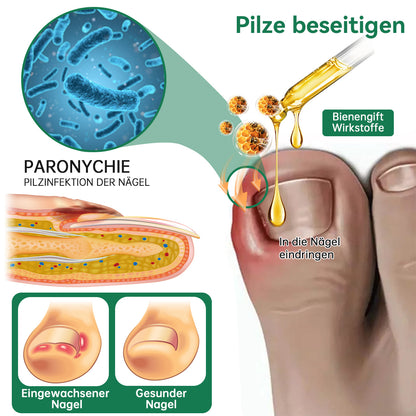 🐝🐝Furzero™ Bienengift Nagelpilz Behandlungslösung:Eine sichere und natürliche Methode zur Nagelbehandlung!👣👣