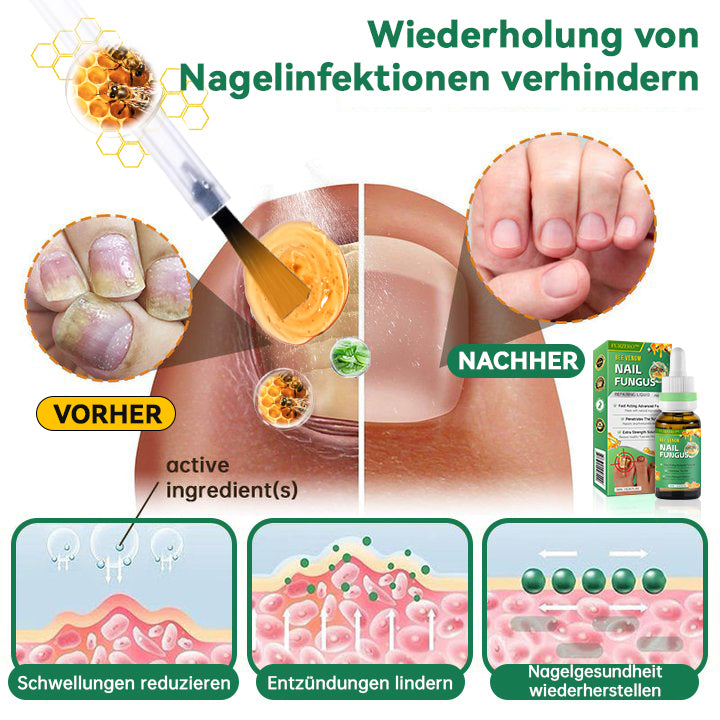 🐝🐝Furzero™ Bienengift Nagelpilz Behandlungslösung:Vollständige Wiederherstellung der Nagelgesundheit👩🏻‍⚕️🌟