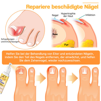 Ourlyard™ Bienengift Nagelpilz Behandlungsspray