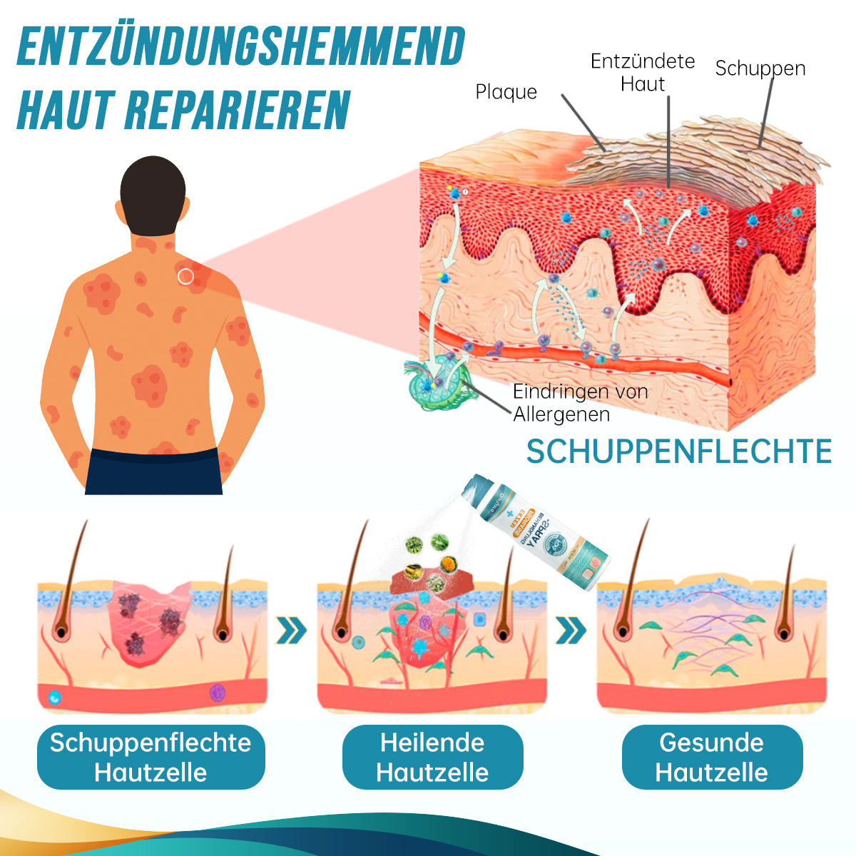 Ourlyard™ Psoriasis- und Ekzem-Naturheilmittel-Spray(🍀Geeignet für alle Hauttypen)