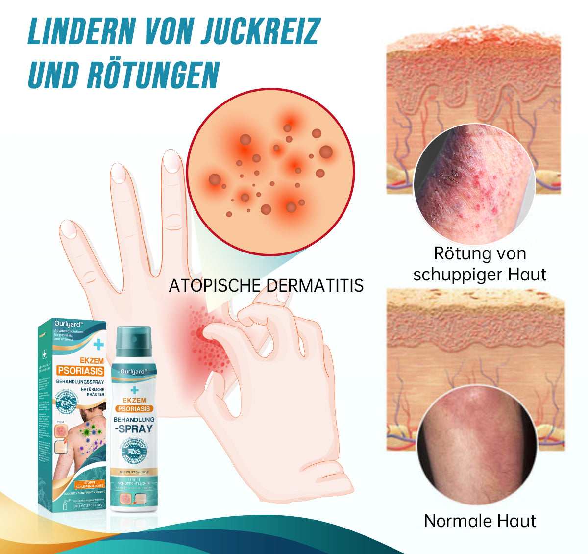 Ourlyard™ Psoriasis- und Ekzem-Naturheilmittel-Spray(🍀Geeignet für alle Hauttypen)