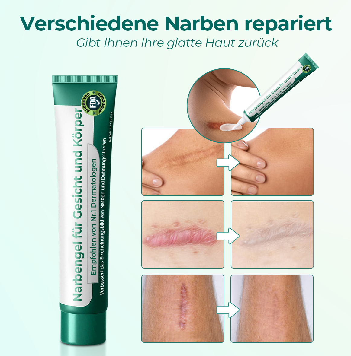 Furzero™ Advanced Medical Grade Stem Cell Scar Gel (🔥🔥 Letzte 30 Minuten zeitlich begrenzter Rabatt)