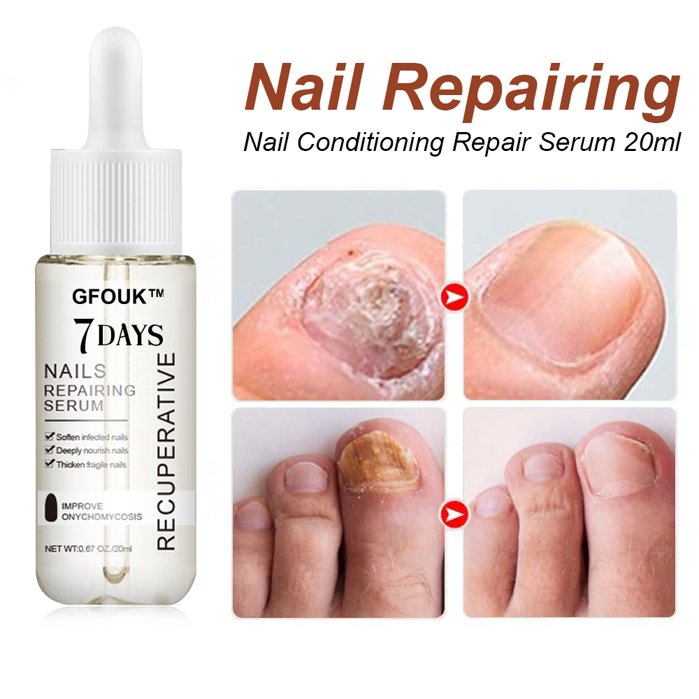 GFOUK™ 7-Tage Nagelwachstum und Stärkung der Nägel 🇩🇪