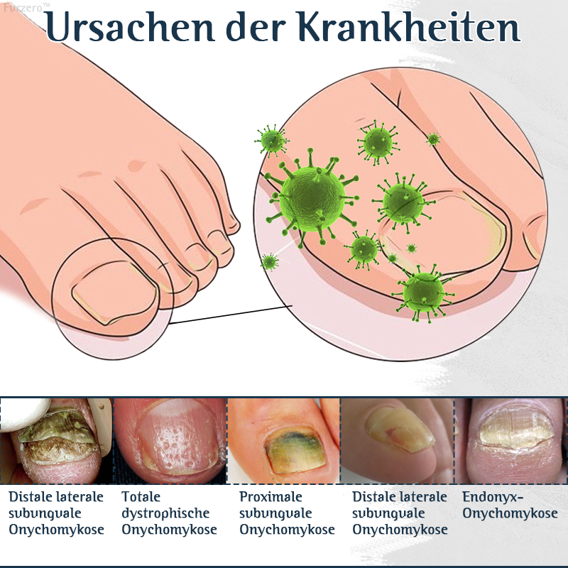 Furzero™ Nachtpflaster zur Behandlung von Nagelpilz