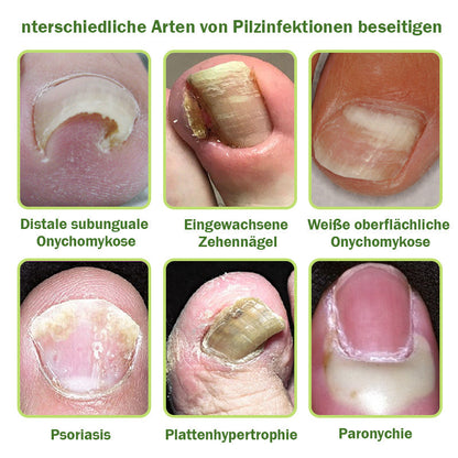 🐝Furzero™ Nagelverteidigung Bienengift-Behandlungsserum pro (Begrenzte Zeit 70% Rabatt)