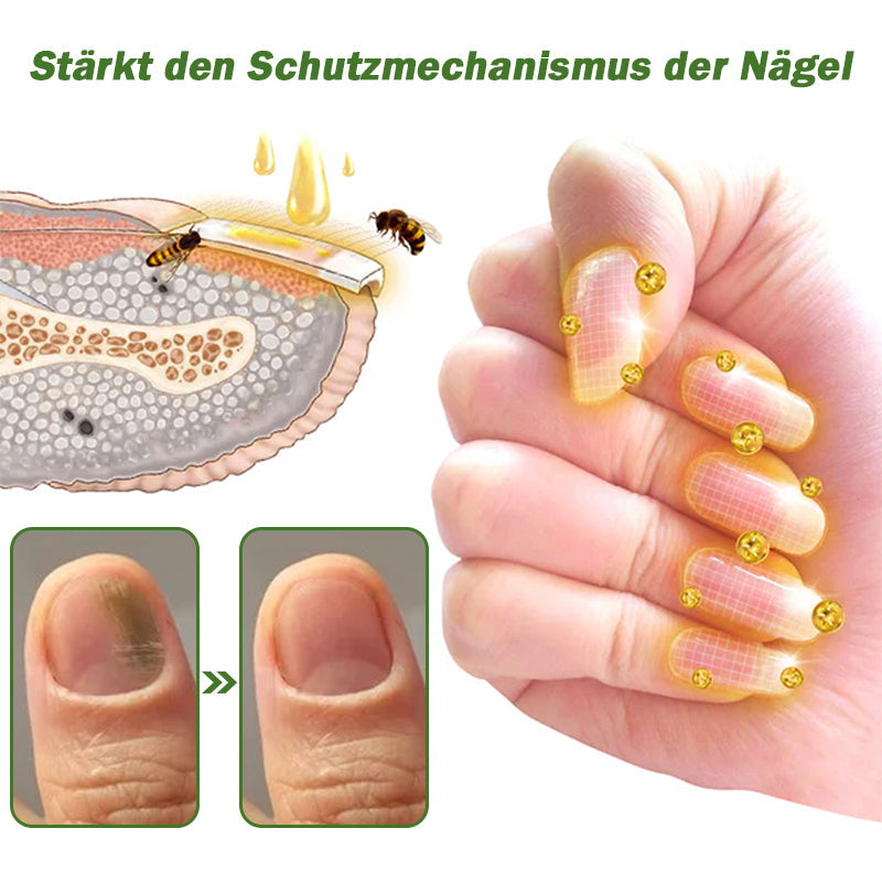 🐝🐝Furzero™ Nagelverteidigung Bienengift-Behandlungsserum pro:Behandlung verschiedener Nagelerkrankungen