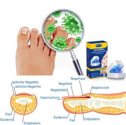 🔥Ourlyard™ Effizientes Lichttherapiegerät zur Behandlung von Nagelerkrankungen