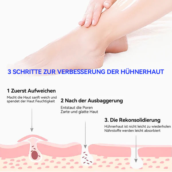 Furzero™ Keratose Pilaris und Akne Behandlung Körper Erfrischend Creme