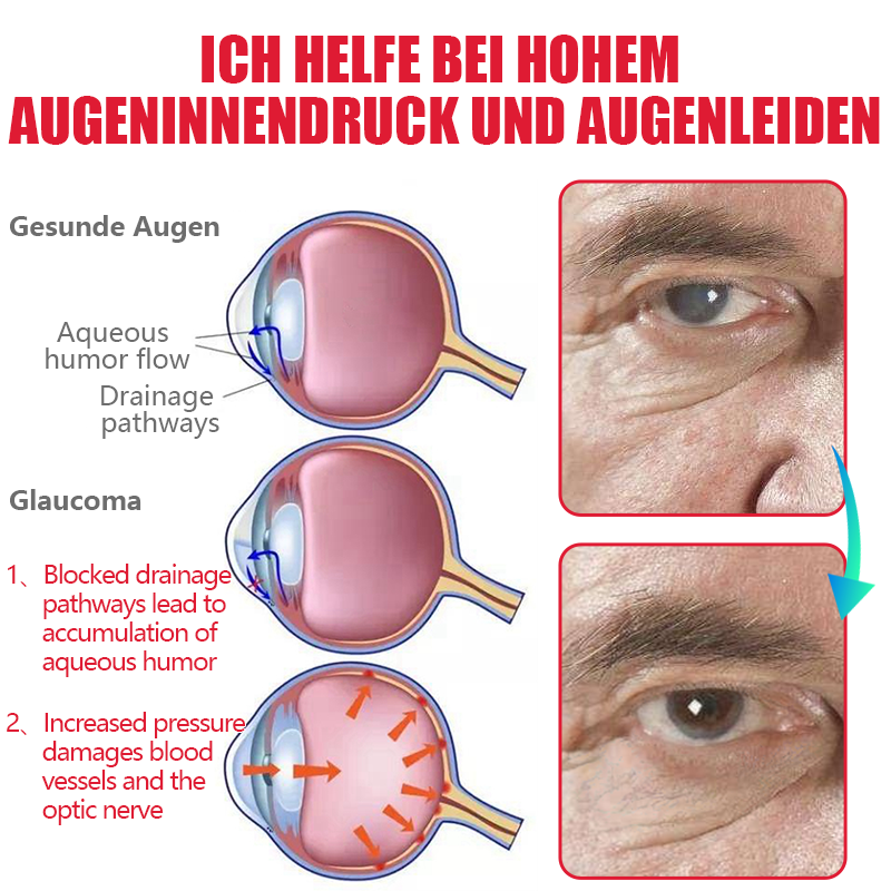 🔥Ourlyard™ Behandlung für Augenprobleme - Lösungstropfen