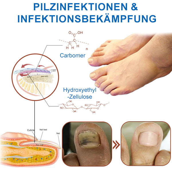 🔥Ourlyard™ Effizientes Lichttherapiegerät zur Behandlung von Nagelerkrankungen