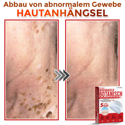 GFOUK® Mikronadeln Botanisch Hautanhängsel Entfernung Patch